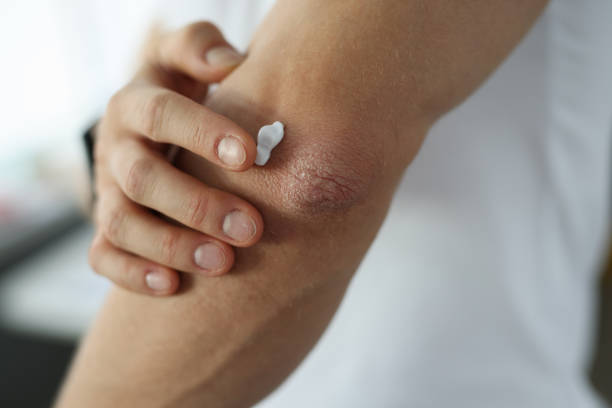 Natural Alternatives to Steroid Creams for Psoriasis