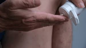 How to Apply Psoriasis Cream for Best Results