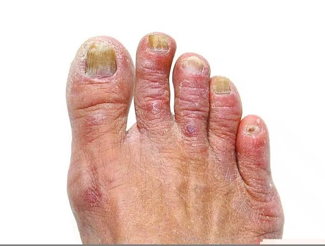 Athlete's Foot Australia