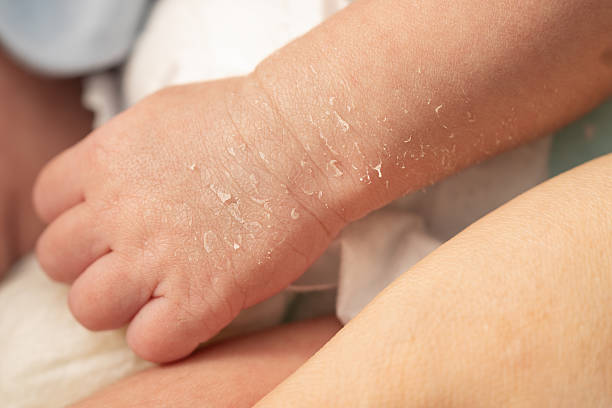 baby eczema australia