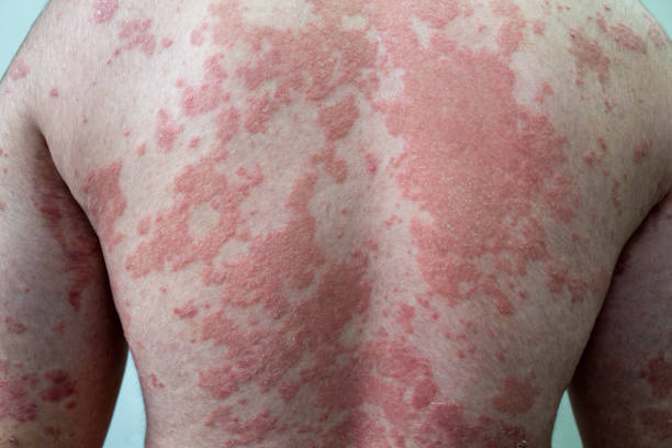 Psoriasis on Back Australia