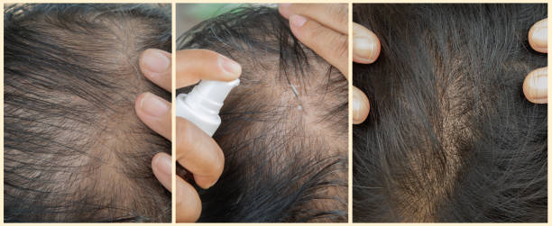 Bee Venom for Hair Loss