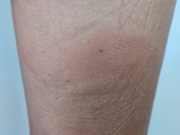 Bee Venom Psoriasis Cream Australia