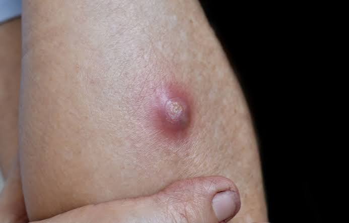 When Folliculitis Turns Into a Boil Australia