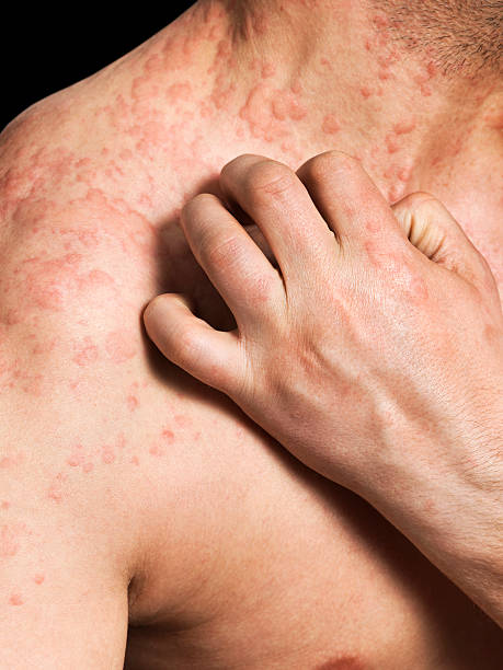 Can Eczema Spread Australia