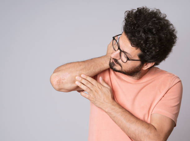can psoriasis leave scars