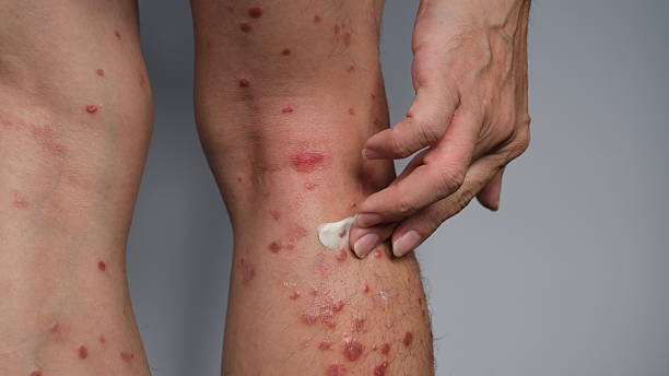 Ceramides for Psoriasis Australia