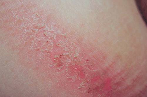 chafing