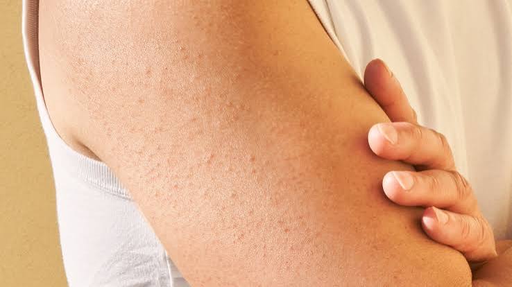 Keratosis Pilaris Treatment Australia