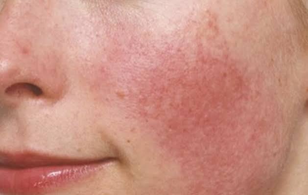Rosacea on Cheeks Australia