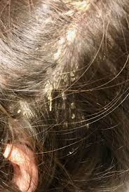 Scalp Psoriasis in Children Australia