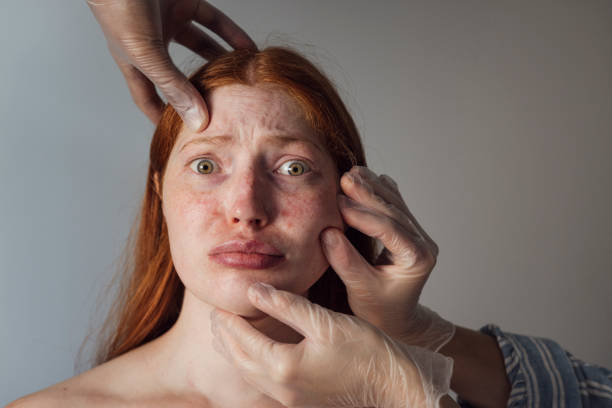 Should I Stop Treatment Now That My Skin Is Clear Australia