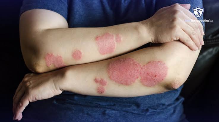 Psoriasis and Antibiotics Australia