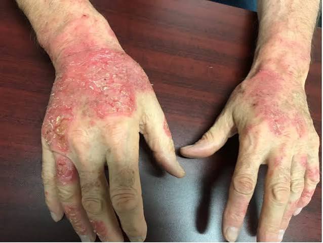 What Causes Contact Dermatitis on Hands Australia?