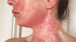 Contact Dermatitis on Face