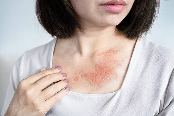 What Is a Contact Allergen Australia