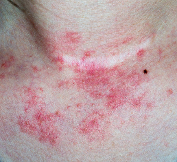 Contact Dermatitis Australia