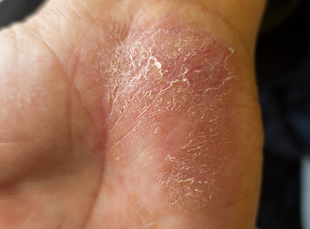 Contact Dermatitis Treatment Australia