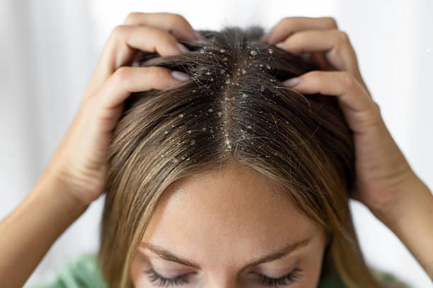 Seborrheic Dermatitis vs Dandruff