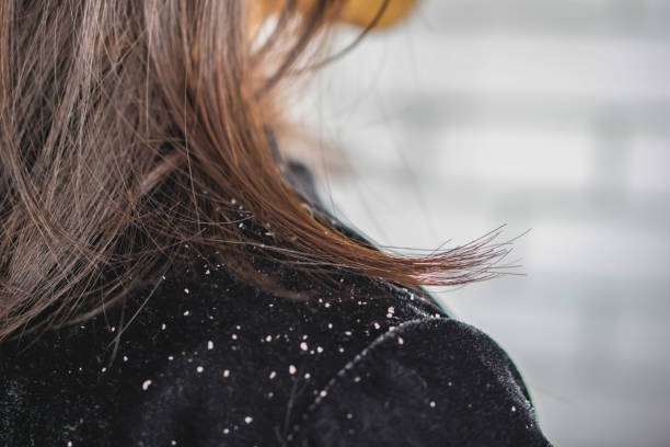 dandruff vs psoriasis
