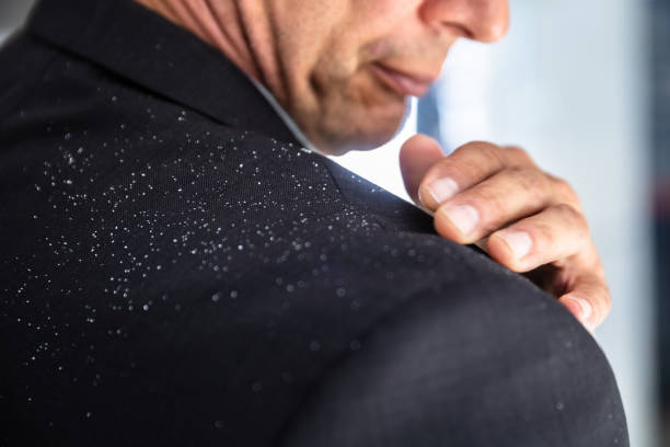 Dandruff Treatment Australia