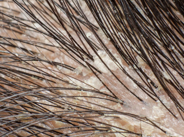 Folliculitis vs Dandruff