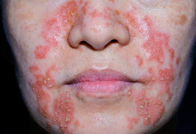Seborrhoeic Dermatitis and Face Masks Australia