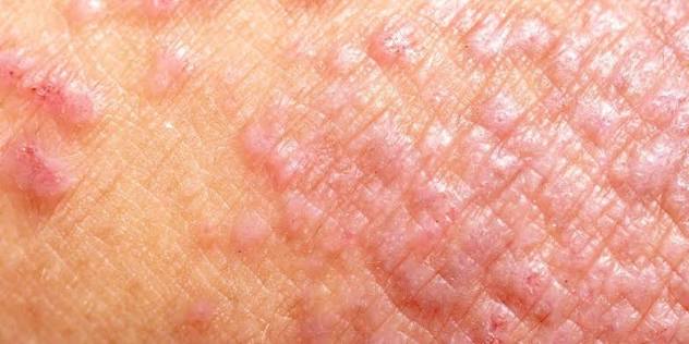 Dermatitis Cream Australia