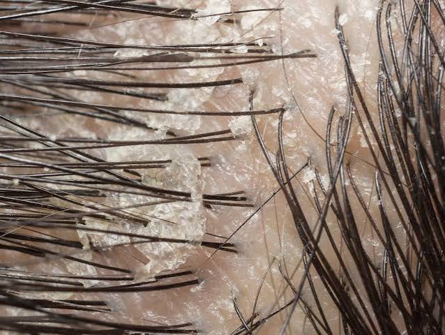 Dry Flaky Scalp Australia
