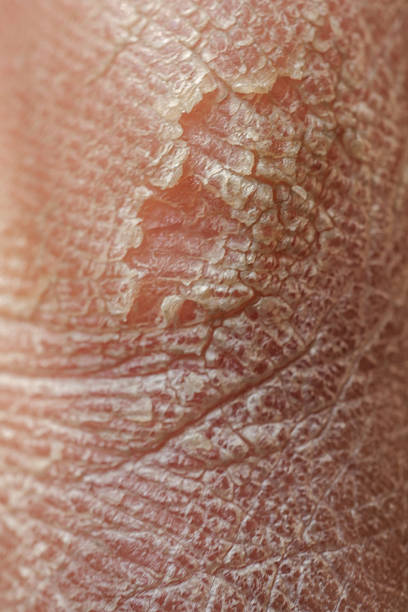 Dry Flaky Skin Australia