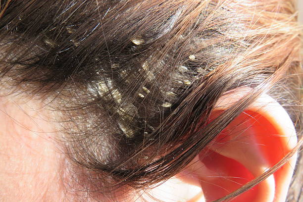 Dry Scalp Treatment Australia