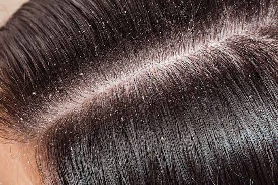 How to Fix Dry Scalp Australia