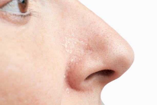 Dry Skin Around Nose Australia