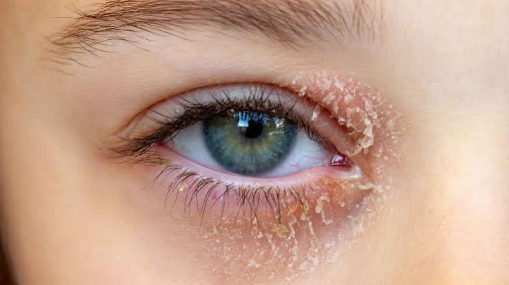 Dry Skin Around Eyes Australia