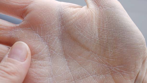 Dry Skin on Hands Australia