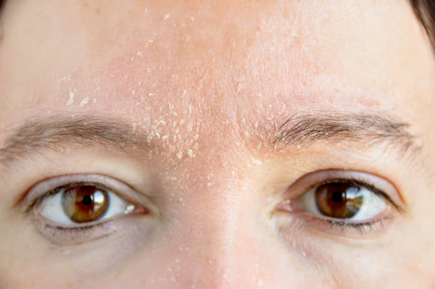 Dry Skin on Face Australia