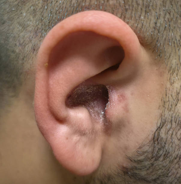 Psoriasis in the Ears Australia