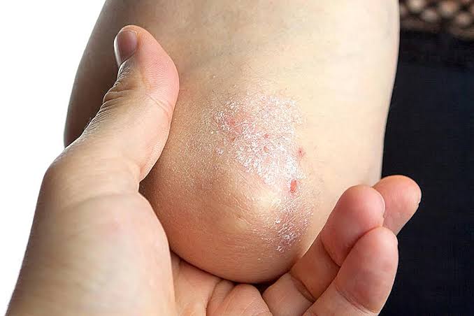 Early Psoriasis Australia