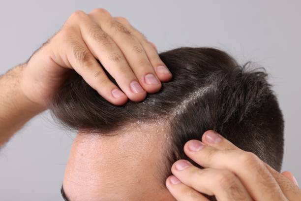Early Signs of Psoriasis