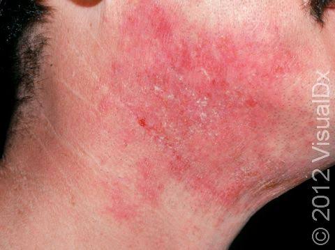 Eczema and Fragrance Australia