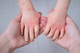 Eczema in Babies vs Toddlers Australia