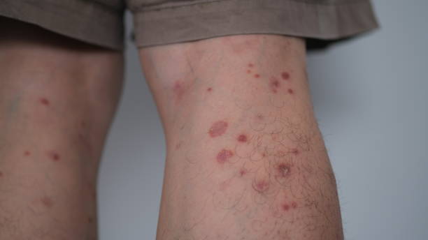 Eczema Behind the Knees Australia