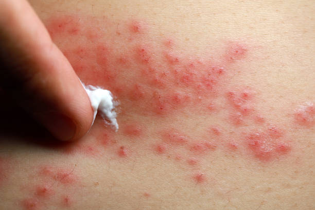 Eczema Cream Australia