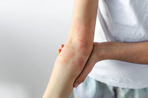 Best Eczema Cream Australia
