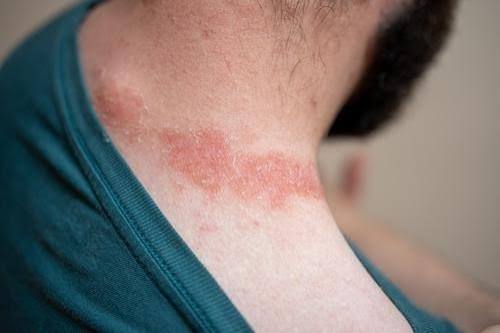 What Causes Eczema Flare Ups