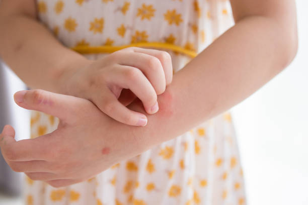 Eczema in Children Australia