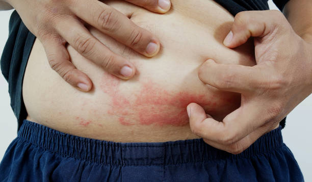 Eczema on Stomach and Abdomen Australia