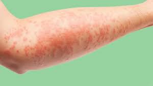 Eczema on Arms Australia