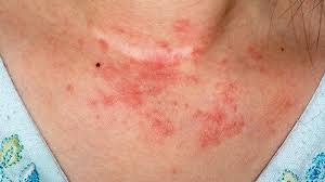 Eczema on Chest Australia
