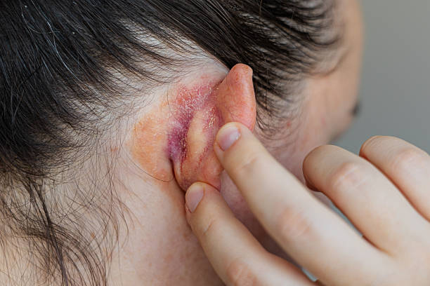 Eczema on Ears Australia